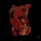 Scoliosis of thoracic spine, severe, VRT: CT - Computed tomography