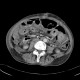 Diffuse peritonitis, dehiscence of rectal anastomosis: CT - Computed tomography