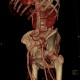 Dilatative form of arteriosclerosis, VRT: CT - Computed tomography