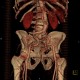 Dilatative form of arteriosclerosis, VRT: CT - Computed tomography
