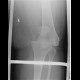 Dislocation of knee joint: X-ray - Plain radiograph