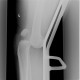 Dislocation of knee joint: X-ray - Plain radiograph