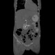 Displacement of duodenobiliary drain: CT - Computed tomography