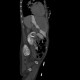 Displacement of duodenobiliary drain: CT - Computed tomography