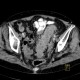 Diverticulitis, acute diverticulitis, peritonitis: CT - Computed tomography