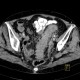 Diverticulitis, acute diverticulitis, peritonitis: CT - Computed tomography