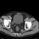 Diverticulum of urinary bladder, excretory phase: CT - Computed tomography