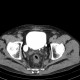 Diverticulum of urinary bladder, excretory phase: CT - Computed tomography