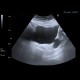 Diverticulum of urinary bladder: US - Ultrasound