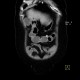 Diverticulum of large bowel with thickened wall: CT - Computed tomography