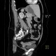 Diverticulum of large bowel with thickened wall: CT - Computed tomography