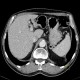 Diverticulum of stomach: CT - Computed tomography