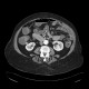 Diverticulosis, colonic diverticulum: CT - Computed tomography