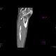 DLBCL of bone and muscle: CT - Computed tomography
