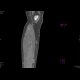 DLBCL of bone and muscle: CT - Computed tomography