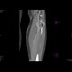 DLBCL of bone and muscle: CT - Computed tomography