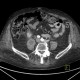 Spondylodiscitis, abscess of psoas muscle, drainage of abscess: CT - Computed tomography
