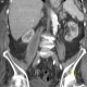 Spondylodiscitis, abscess of psoas muscle, drainage of abscess: CT - Computed tomography