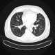Tree-in-bud pattern: CT - Computed tomography