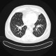 Tree-in-bud pattern: CT - Computed tomography