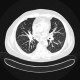 Tree-in-bud pattern: CT - Computed tomography