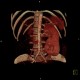 Duplex kidney: CT - Computed tomography