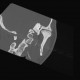 Dysplasia of head of mandible, bilateral: CT - Computed tomography