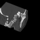 Dysplasia of head of mandible, bilateral: CT - Computed tomography