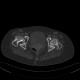 Dysplasia of femoral head: CT - Computed tomography
