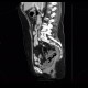 Uterus, mimics a presacrall mass, extirpation of anus: CT - Computed tomography