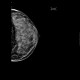 Mammography, dense type, normal finding: MMG - Mammography