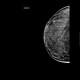 Mammography, dense type, normal finding: MMG - Mammography