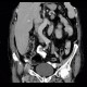 Dermoid of ovary: CT - Computed tomography