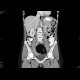 Dermoid of the ovary: CT - Computed tomography