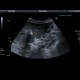 Obstruction of biliary stent, dilated intrahepatic biliary ducts: US - Ultrasound