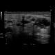 Dilated Wharton's duct, sialolithiasis: US - Ultrasound