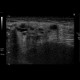 Dilated Wharton's duct, sialolithiasis: US - Ultrasound