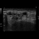 Dilated Wharton's duct, sialolithiasis: US - Ultrasound