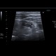 Acute diverticulitis, sigmoid colon: US - Ultrasound