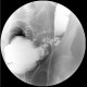 Diverticular disease of the sigmoid colon: RF - Fluoroscopy