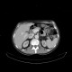 Dorsocaudal branch of the portal vein: CT - Computed tomography