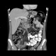 Dorsocaudal branch of the portal vein: CT - Computed tomography