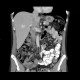Dorsocaudal branch of the portal vein: CT - Computed tomography