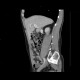 Dorsocaudal branch of the portal vein: CT - Computed tomography