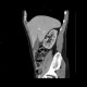 Dorsocaudal branch of the portal vein: CT - Computed tomography