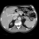 Dorsocaudal branch of the portal vein: CT - Computed tomography