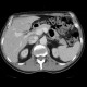 Dorsocaudal branch of the portal vein: CT - Computed tomography