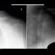 Posterior dislocation of glenohumeral joint, following reposition: X-ray - Plain radiograph