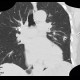 Chest tube, pleural drain: CT - Computed tomography