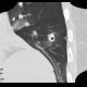 Chest tube, pleural drain: CT - Computed tomography